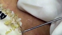 Cyst- Blackheads- Pimples- Acne- Steatocystoma 7
