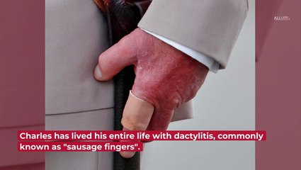 Doctor Explains Why Charles' Fingers Seem Swollen On Occasion