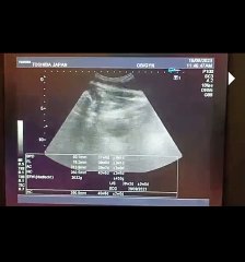 5  Male ♂️Gender at 37_38 Week with Difficult Sex Determination