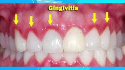 bd-enfermedades-que-pueden-transmitirse-por-un-beso-191023