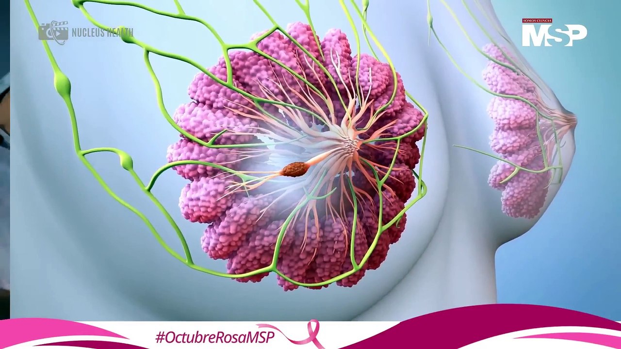 Día internacional de la lucha contra el cáncer de mama: 3 opciones de tratamiento para enfrentarlo