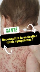 Reconnaître la varicelle : Quels symptômes ?