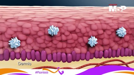 ¿Qué es la psoriasis y cómo afecta a tu piel? 🩺