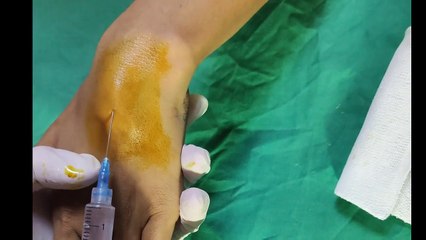 Ganglion Cyst Aspiration and Steroid Injection  Ganglion Cyst Removal  Ganglionic Cyst Ka Ilaj