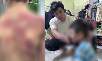 Bé trai 5 tuổi bị cha đánh thương tích khắp người