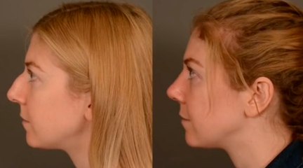 Vaikuttaja kannustaa yleisöään tekemään plastiikkakirurgiaa