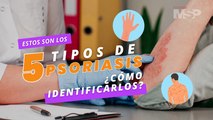 Los 5 tipos de psoriasis que existen: ¿Cómo identificarlos? - #ExclusivoMSP