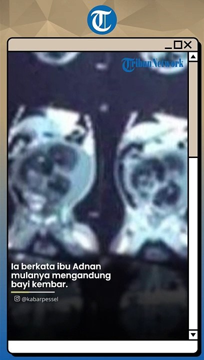 Dikira Kembung Bayi 5 Bulan di Sumbar Ternyata Hamil Kembarannya