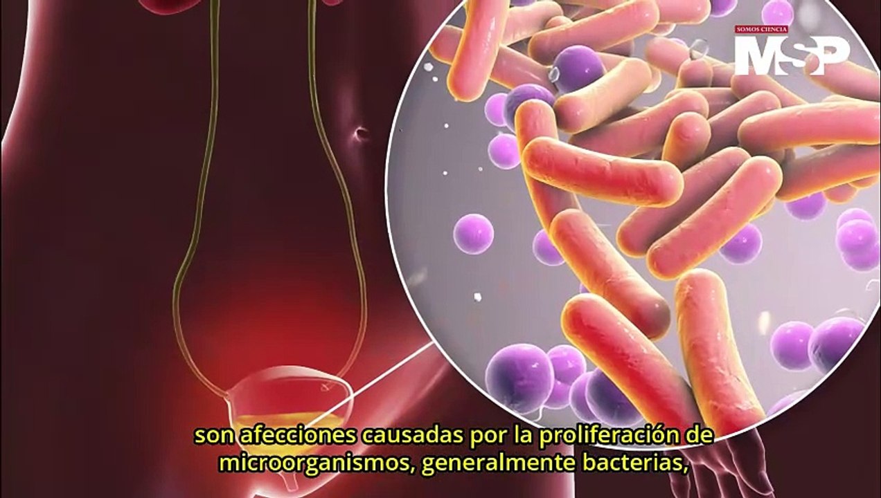 ¿Cómo funcionan las infecciones urinarias? - #ExclusivoMSP