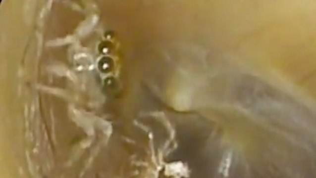 Moment doctor discovers tiny spider living deep inside woman’s ear