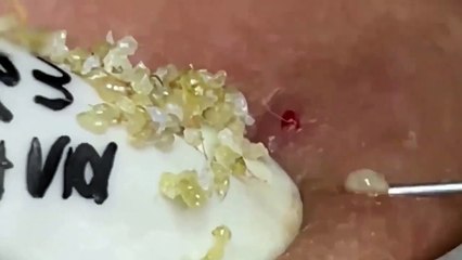 Blackheads- Pimples- Acne- Steatocystoma