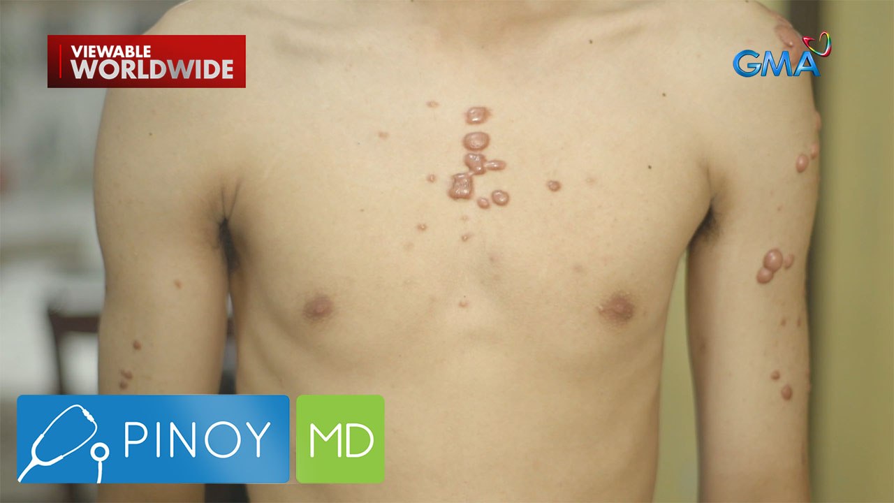 Keloid ng isang binata, kumalat daw mula sa dibdib hanggang binti?! | Pinoy MD