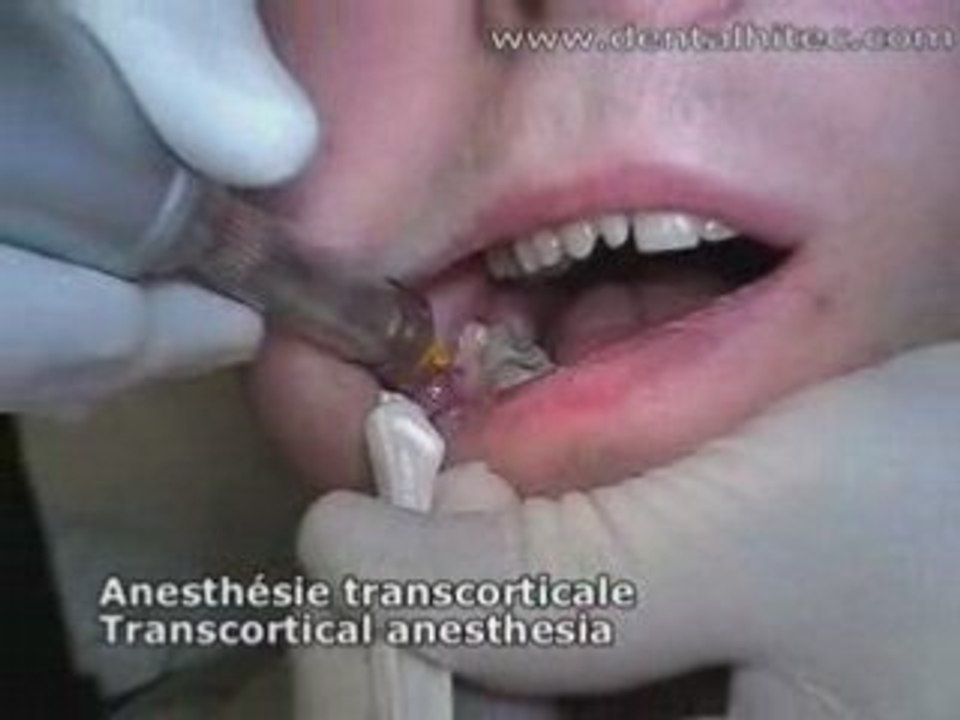 Anesthésie de dent de sagesse au Quicksleeper