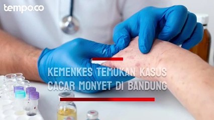 Bertambah Lagi, Kemenkes Temukan Kasus Cacar Monyet di Bandung