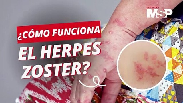 ¿Qué es el herpes zóster o “culebrilla” y cómo funciona en el cuerpo