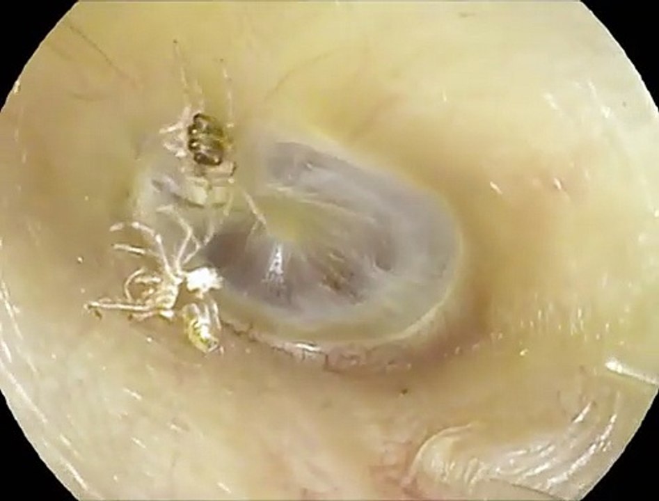 Une araignée piégée dans l'oreille : Une taïwanaise aux prises avec des "bruits incessants"