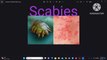 scabies part2/scabies ka ilaj/scabies home treatment/scabies treatment /scabies symptoms/health everywhere