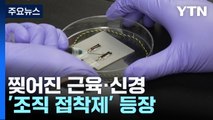 찢어진 근육·신경 붙이는 '조직 접착제' 등장 / YTN
