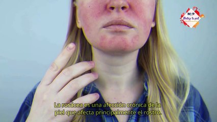 Rosácea: ¿Cómo funciona en la piel? - #ExclusivoMSP