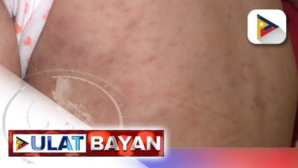 DOH: Bilang ng mga kaso ng tigdas sa bansa, tumaas ng 300% ngayong taon