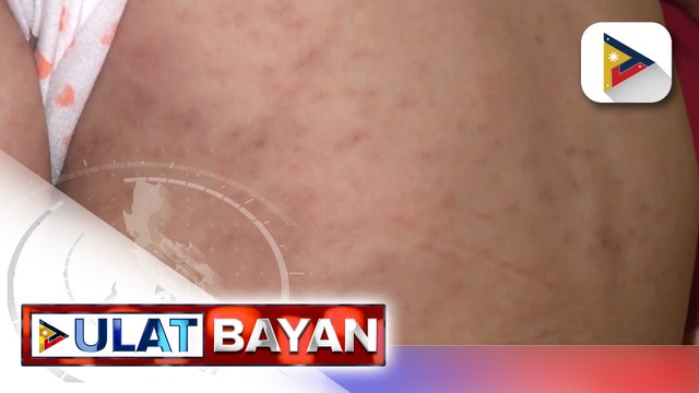 DOH: Bilang ng mga kaso ng tigdas sa bansa, tumaas ng 300% ngayong taon