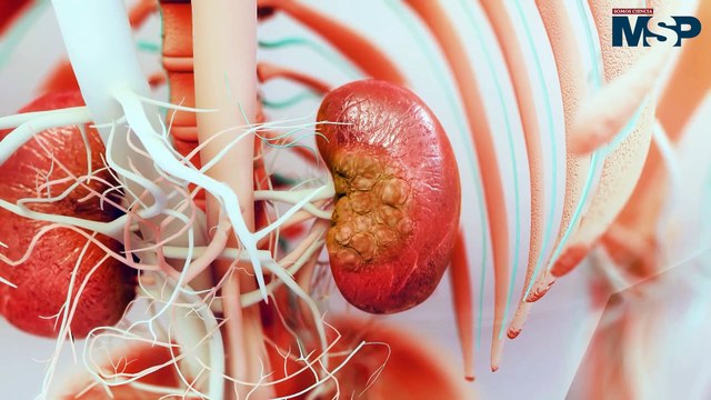 Oncóloga explica todo lo que debes saber sobre el cáncer de riñón - #ExclusivoMSP