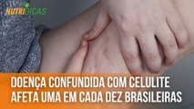 Doença confundida com celulite afeta uma em cada dez brasileiras | Nutridicas