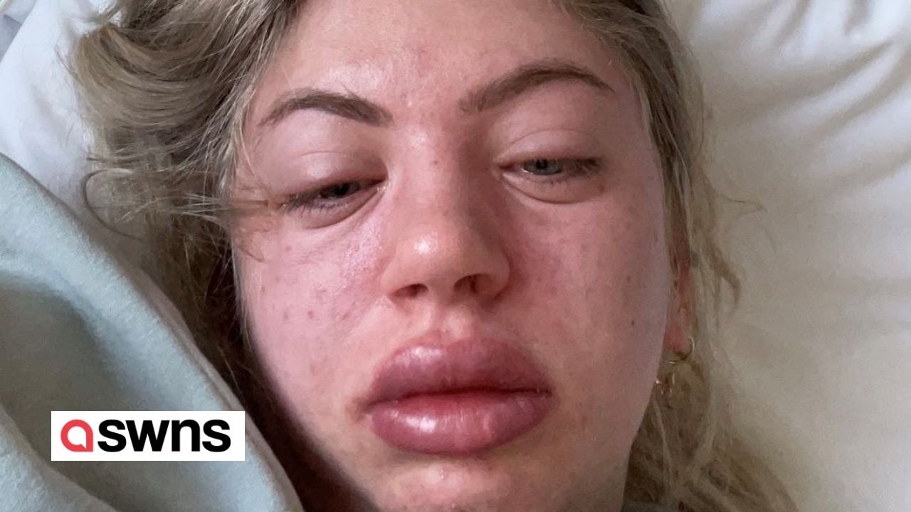 Lash tech forced to give up job after it triggered allergy to