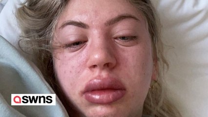 Lash tech forced to give up job after it triggered allergy to ‘everything’