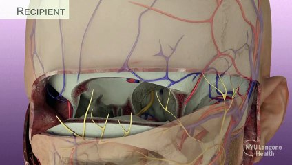 Cirurgiões dos EUA realizam primeiro transplante completo de olho do mundo