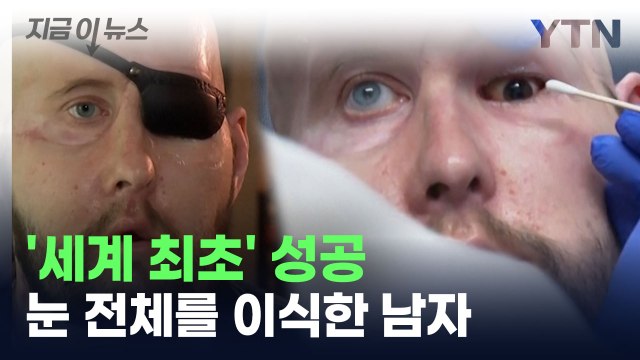 '세계 최초 성공' 눈 전체를 이식한 남자...현재 상태는? [지금이뉴스] / YTN