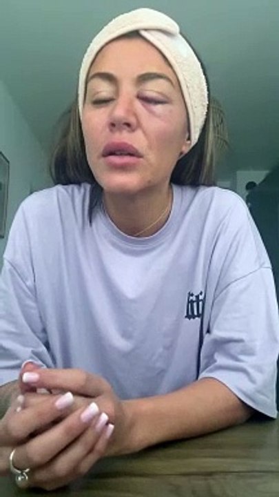 Anaïs Camizuli a été agresséeAnaïs Camizuli révèle avoir été frappée par un inconnu dans la rue le 12 novembre 2023.