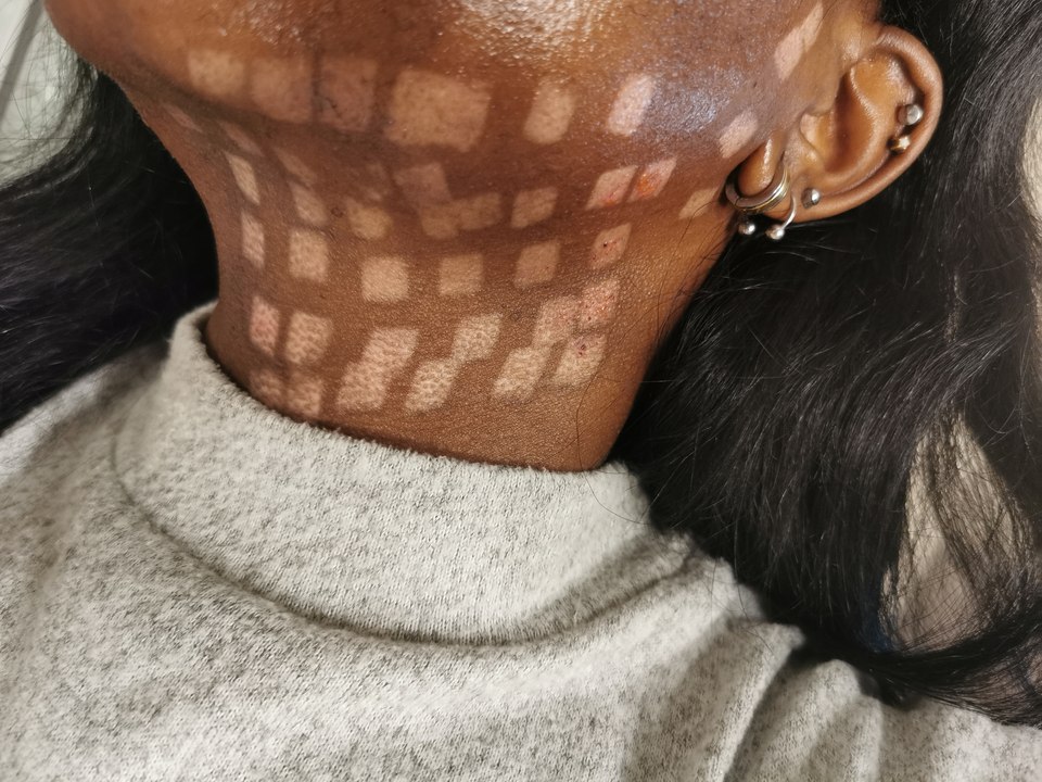 Laser hair removal leaves woman with burns like a chessboard on her face and neck