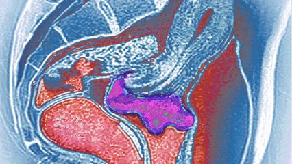 Gebärmutterhalskrebs: Dieses Symptom kann man tatsächlich riechen