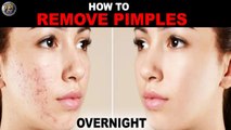 How To Remove Pimples Overnight । Home Remedy For Pimple On Face - Acne Treatment । IWC-5।