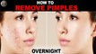 How To Remove Pimples Overnight । Home Remedy For Pimple On Face - Acne Treatment । IWC-5।