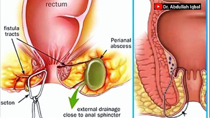 Fistula _ What is Peri-anal Fistula_ _ Fistula Causes_ Find out Best treatment without surgery