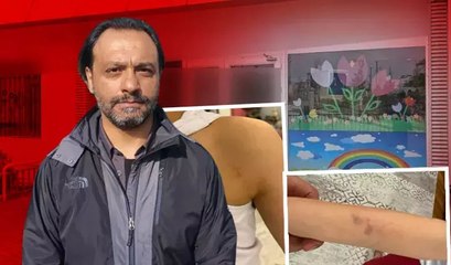 Özel anaokulunda skandal! Çocuğunun vücudunu gören baba soluğu savcılıkta aldı