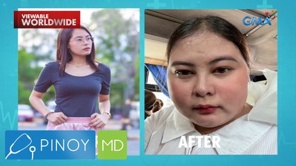 Paglobo ng katawan ng isang dalaga, epekto raw ng gamot sa pananakit ng ulo?! | Pinoy MD