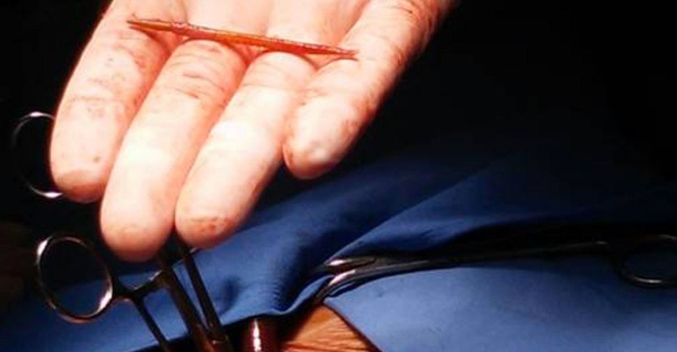 Ils retrouvent un cure-dent dans son COEUR 