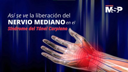 Así se ve la liberación del nervio mediano en el Síndrome del Túnel Carpiano - ​​#MSPCiencia
