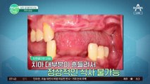 네비게이션 임플란트? 치아 상실의 새로운 치료법! 예방법까지 대공개