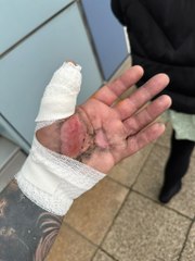E-cigarette explodes and melts into man's hand