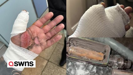 下载视频: Man suffers horror injuries after e-cigarette exploded in his hand