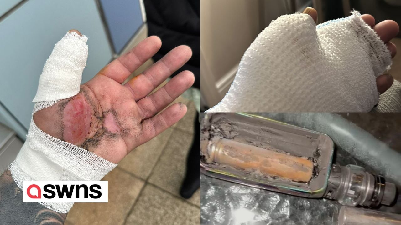 Man suffers horror injuries after e-cigarette exploded in his hand