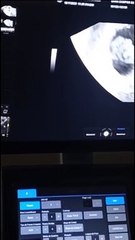 Mãe descobre gravidez de quíntuplos aos 18 anos