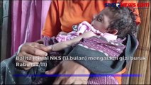 Setiap Hari Makan Ubi dan Pisang, Balita Idap Gizi Buruk di Sikka