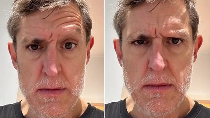 Louis Theroux shares alopecia health update as he asks fans for advice