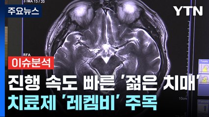 [뉴스라이더] '50세' 김창옥 "알츠하이머 의심"...'젊은치매' 발병 원인은? / YTN