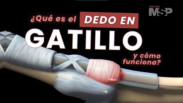 ¿Qué es el dedo en gatillo o trigger finger y cómo funciona? - #ExclusivoMSP